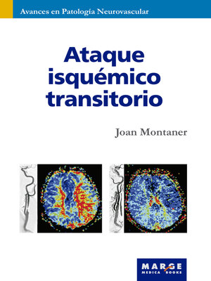 cover image of Ataque isquémico transitorio